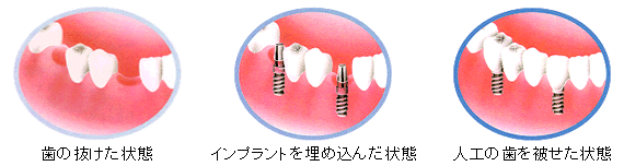歯の抜けた状態⇒インプラント埋め込み⇒人口の歯を被せる